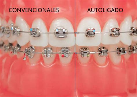 diferencia entre brackets metalicos y autoligables|autoligado vs brackets convencionales.